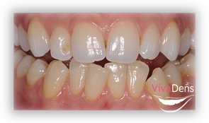 Whitening upper teeth
