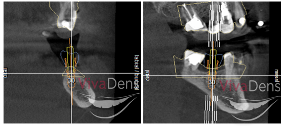 Pav.: 3D rentgeno nuotraukoje matomas suplanuotas būsimo vainiko ir implanto vaizdas