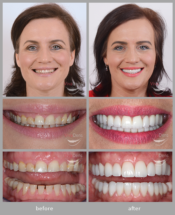 Periodontology. Photo before and after surgical recontouring of gingiva and jaw bone.