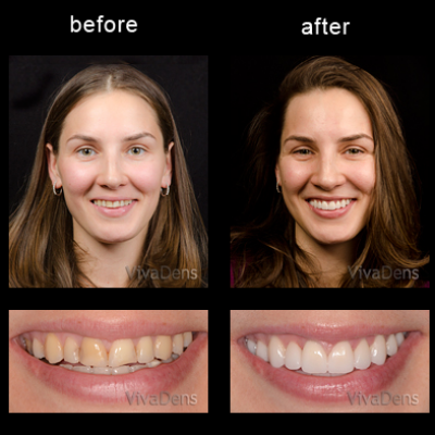 Indirect aesthetic restoration with CEREC in one day