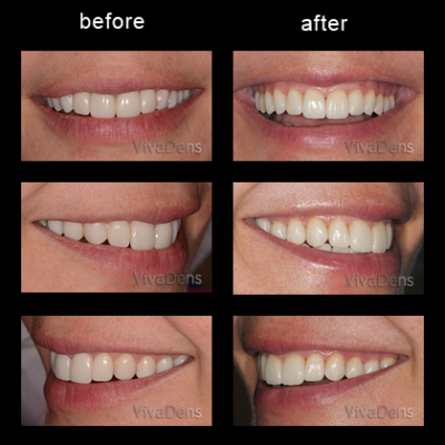 Indirect aesthetic restoration with CEREC in two days