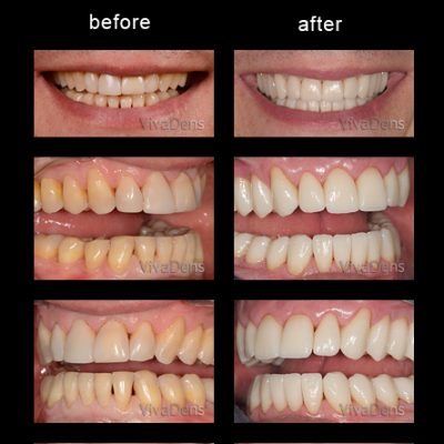 Indirect aesthetic restoration with CEREC in two days