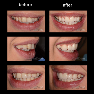 Indirect aesthetic restoration with CEREC in one day
