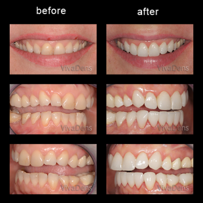 Indirect aesthetic restoration with CEREC in three days