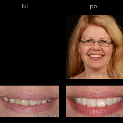 Estetinis dantų protezavimas CAD/CAM - CEREC, 3Shape