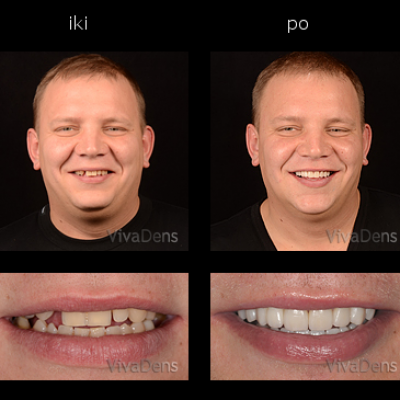 Estetinis dantų protezavimas CAD/CAM - CEREC, 3Shape 