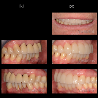 Estetinis dantų protezavimas CAD/CAM - CEREC, 3Shape