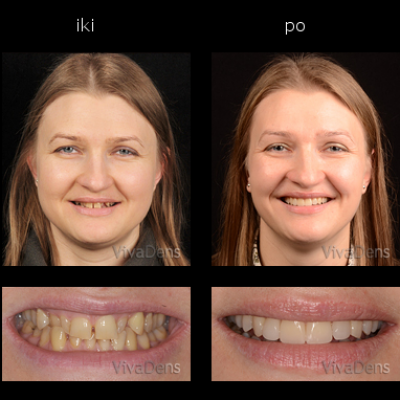 Greita estetinė suaugusiųjų ortodontija ir keramikos laminatės su CAD/CAM