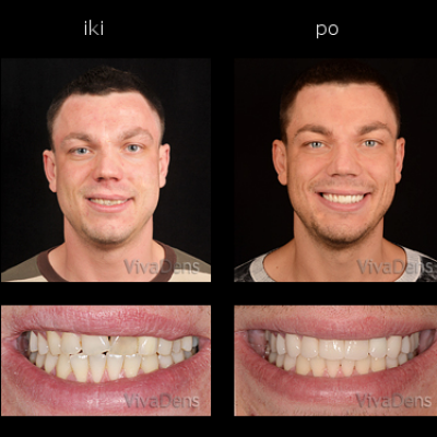 Greita estetinė suaugusiųjų ortodontija ir keramikos laminatės su CAD/CAM