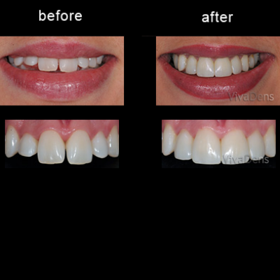 Changing teeth form