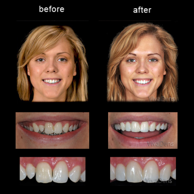 Changing teeth form