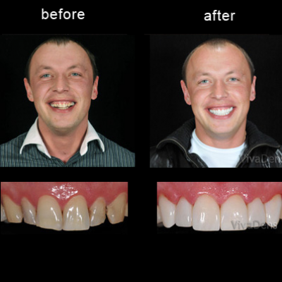 Restoration of discolored teeth