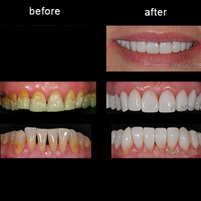 Restoration of discolored teeth