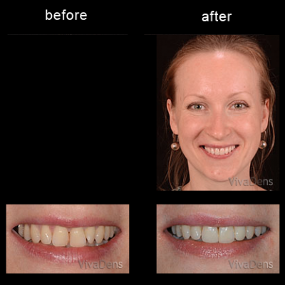 Restoration of teeth damaged by caries