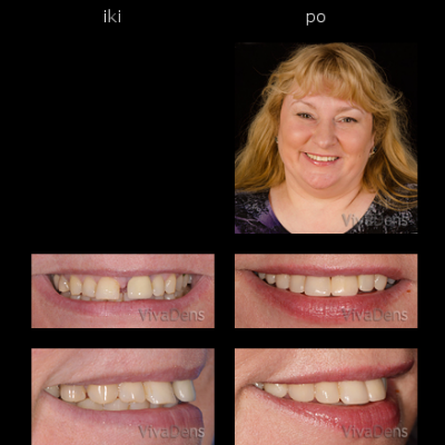 Greita estetinė ortodontija ir estetinis protezavimas ant implantų