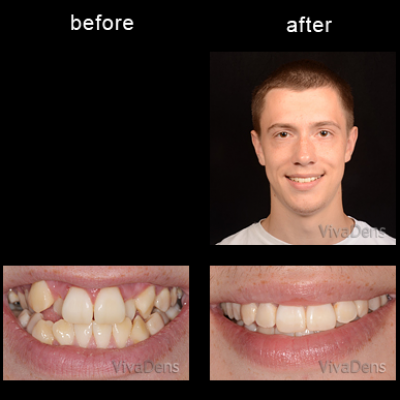 Short-Term Ortho Six Month Smiles