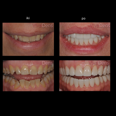 Greitoji estetinė suaugusiųjų ortodontija ir keramikos laminatės
