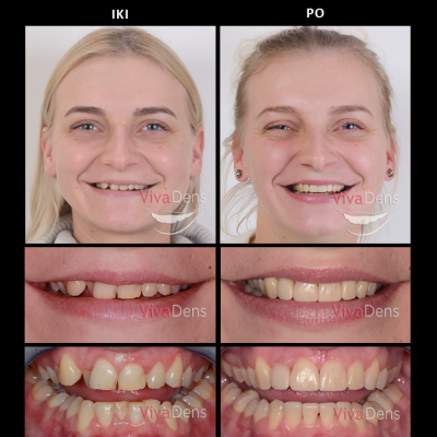 Greita estetinė suaugusiųjų ortodontija ir estetinis plombavimas