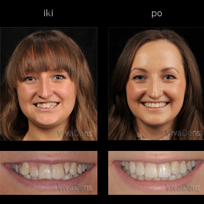 Greitoji estetinė suaugusiųjų ortodontija 