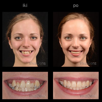 Greitoji estetinė suaugusiųjų ortodontija