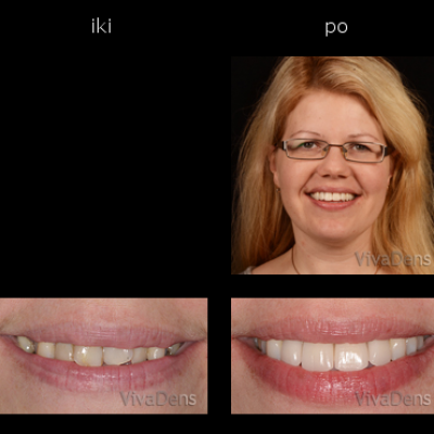 Greitoji estetinė suaugusiųjų ortodontija ir CEREC restauracijos