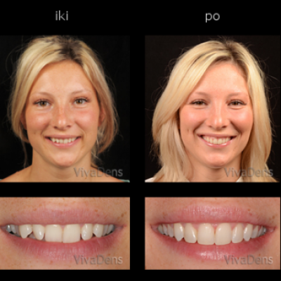 Greitoji estetinė suaugusiųjų ortodontija