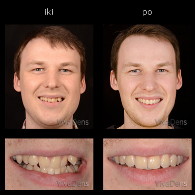 Greitoji estetinė suaugusiųjų ortodontija.Sangrūdos rekonstrukcija