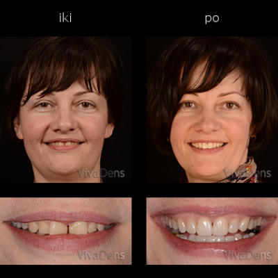 Greitoji estetinė suaugusiųjų ortodontija   (skaidriais breketais)